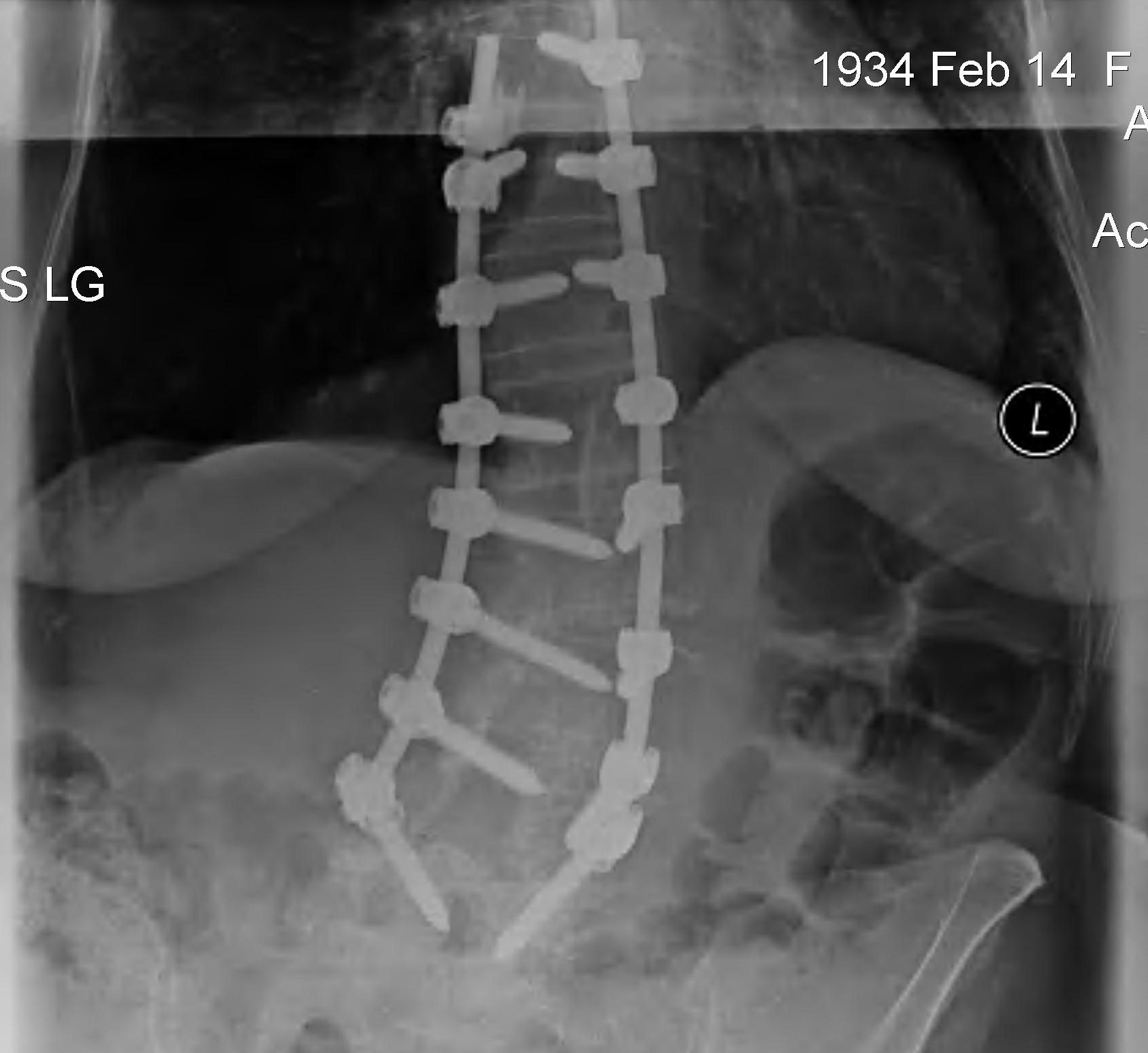 Fusion Degenerative Scoliosis